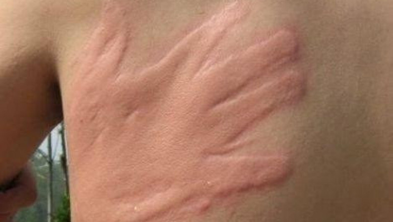 Попросил друга убить комара