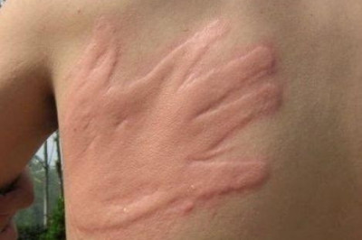 Попросил друга убить комара