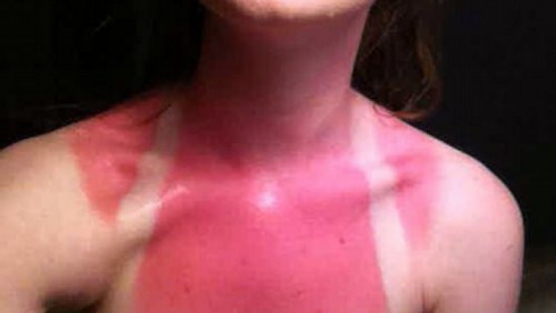 Не забывайте , что загорать надо с умом !