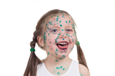 Ветрянка – болезнь детская